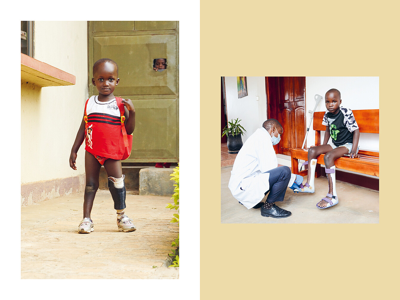 Child with prosthetic leg standing outside a building wearing a red dress and sneakers; a healthcare worker fitting a prosthetic leg on a seated child inside a room with wooden bench and plant.